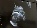 USG płodu w Holandii. Obraz z kliniki NovaMed pokazuje profil dziecka.