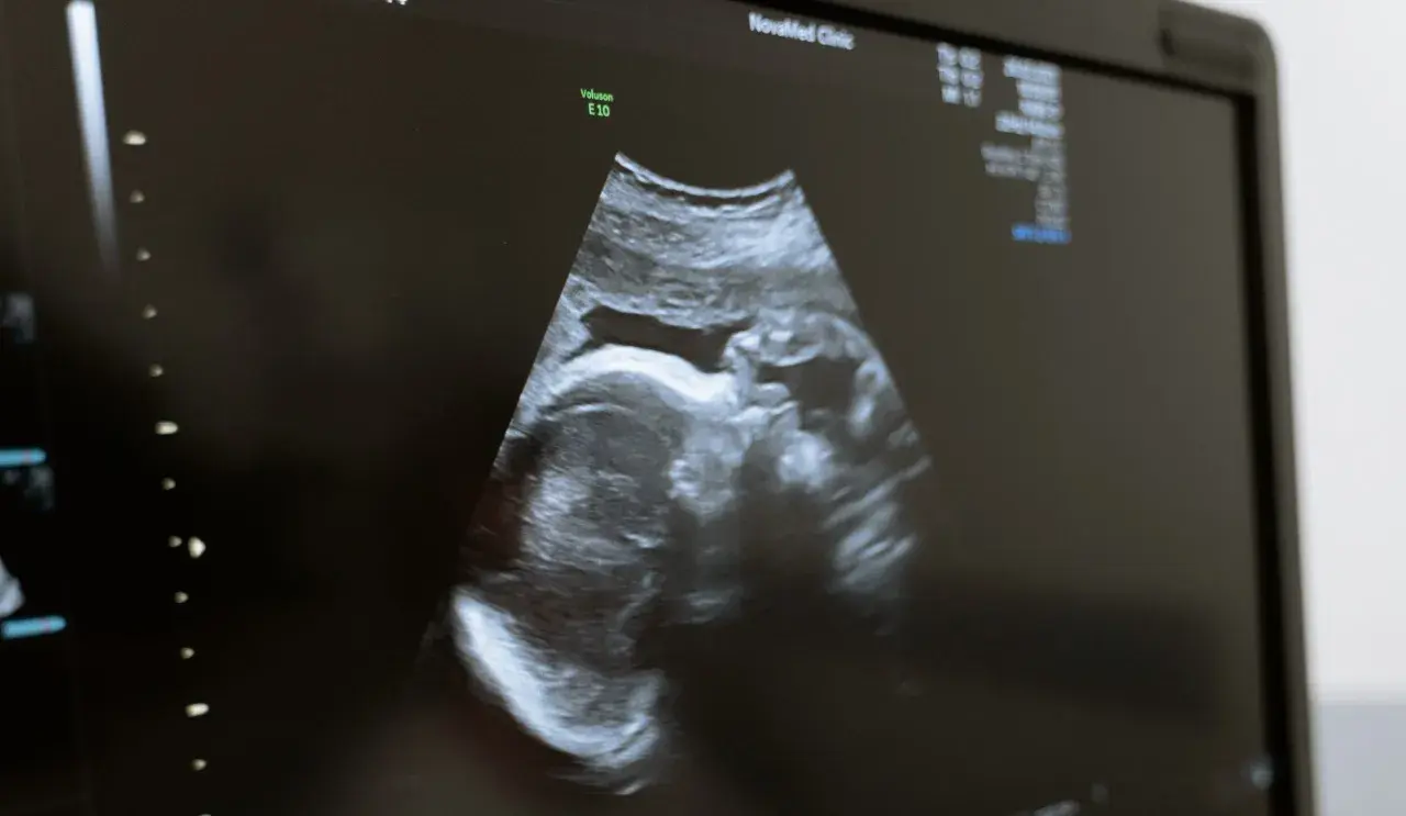 USG płodu w Holandii. Obraz z kliniki NovaMed pokazuje profil dziecka.