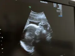 USG płodu w Holandii. Obraz z kliniki NovaMed pokazuje profil dziecka.