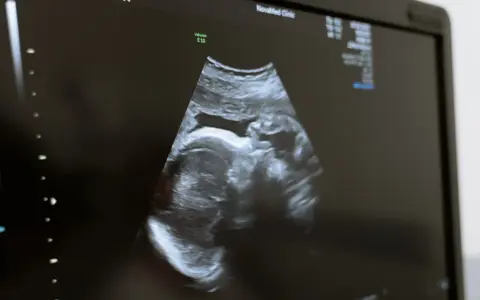 USG płodu w Holandii. Obraz z kliniki NovaMed pokazuje profil dziecka.