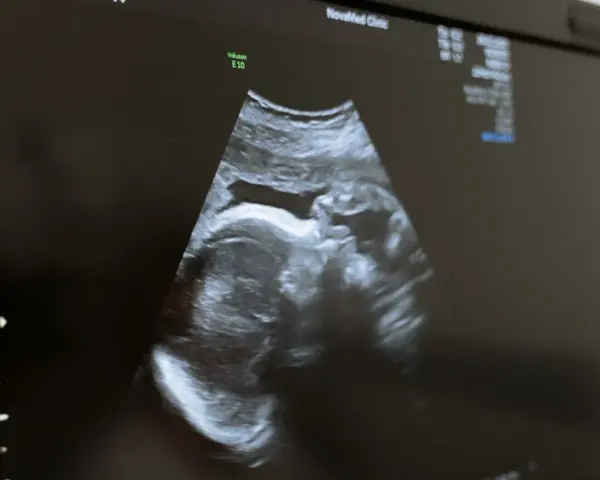 USG płodu w Holandii. Obraz z kliniki NovaMed pokazuje profil dziecka.