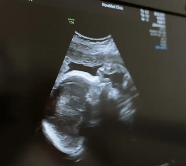 USG płodu w Holandii. Obraz z kliniki NovaMed pokazuje profil dziecka.