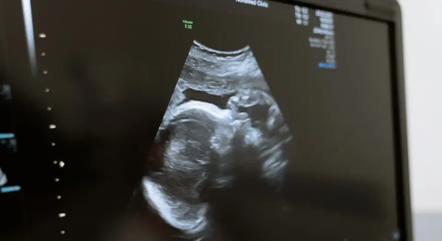 USG płodu w Holandii. Obraz z kliniki NovaMed pokazuje profil dziecka.